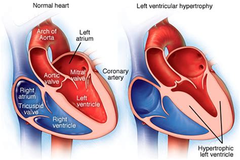 lv dilatation causes|mildly dilated left ventricle symptoms.